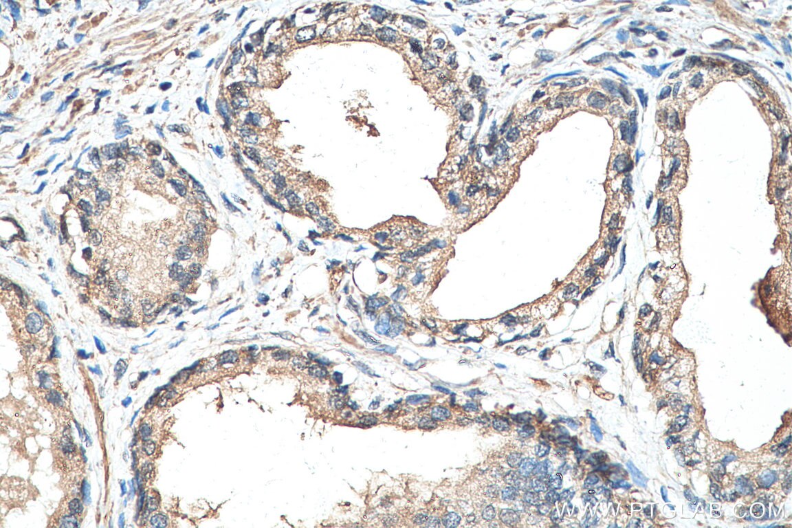 Immunohistochemistry (IHC) staining of human prostate cancer tissue using FBXO6 Polyclonal antibody (11830-1-AP)