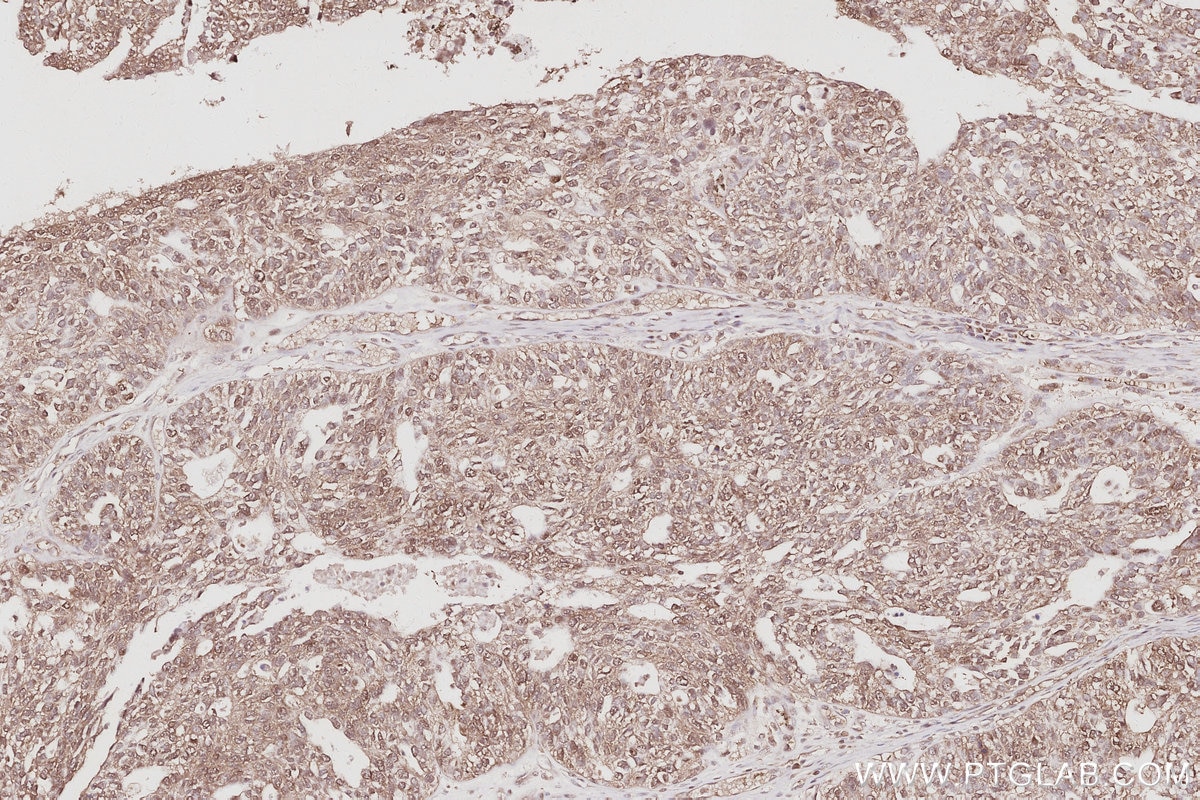 Immunohistochemistry (IHC) staining of human ovary cancer tissue using FBXO7 Polyclonal antibody (10696-1-AP)