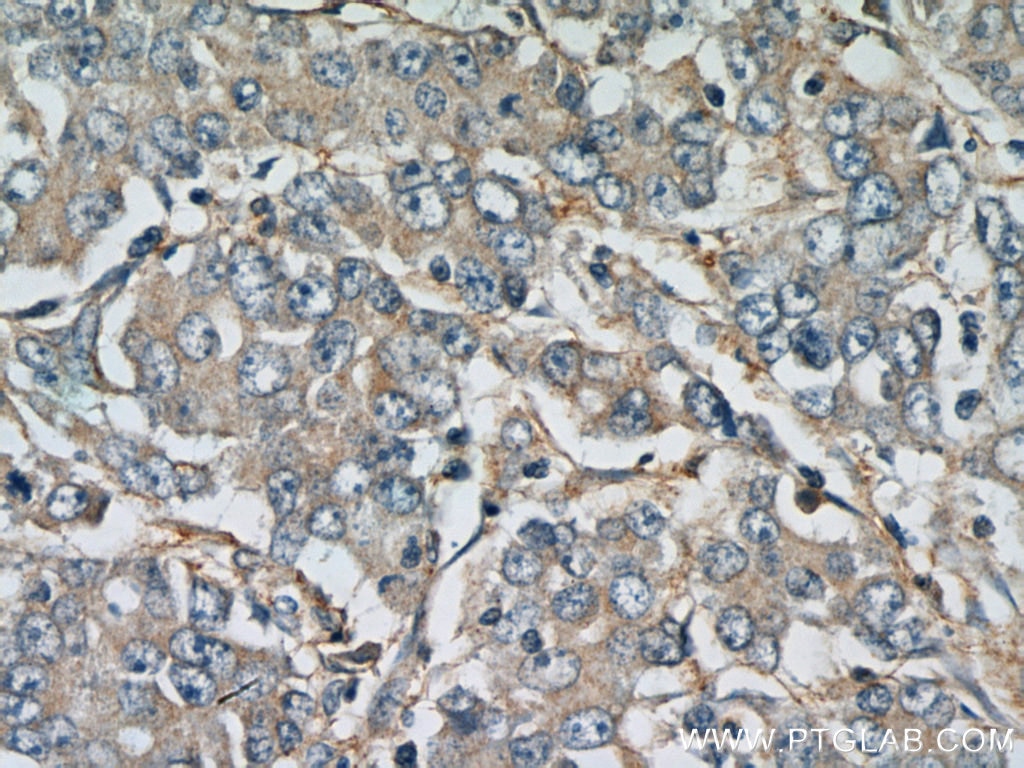 Immunohistochemistry (IHC) staining of human stomach cancer tissue using FBXW11 Polyclonal antibody (13149-1-AP)