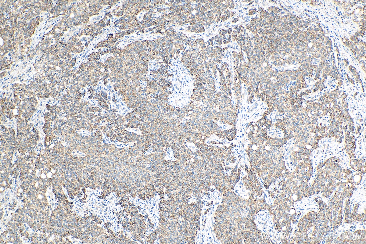 IHC staining of human stomach cancer using 68090-1-Ig