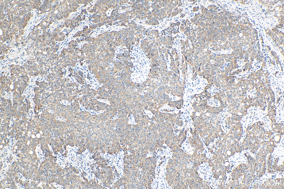 Immunohistochemistry (IHC) staining of human stomach cancer tissue using FBXW11 Monoclonal antibody (68090-1-Ig)