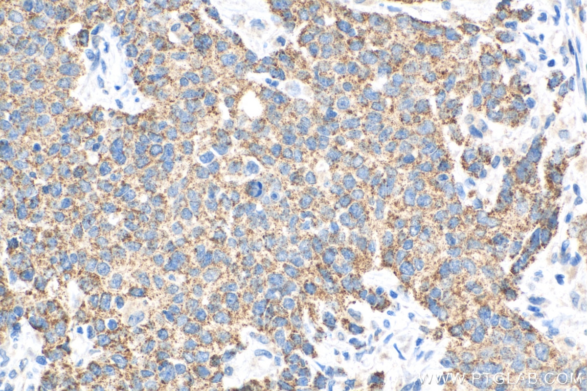 Immunohistochemistry (IHC) staining of human stomach cancer tissue using FBXW11 Monoclonal antibody (68090-1-Ig)