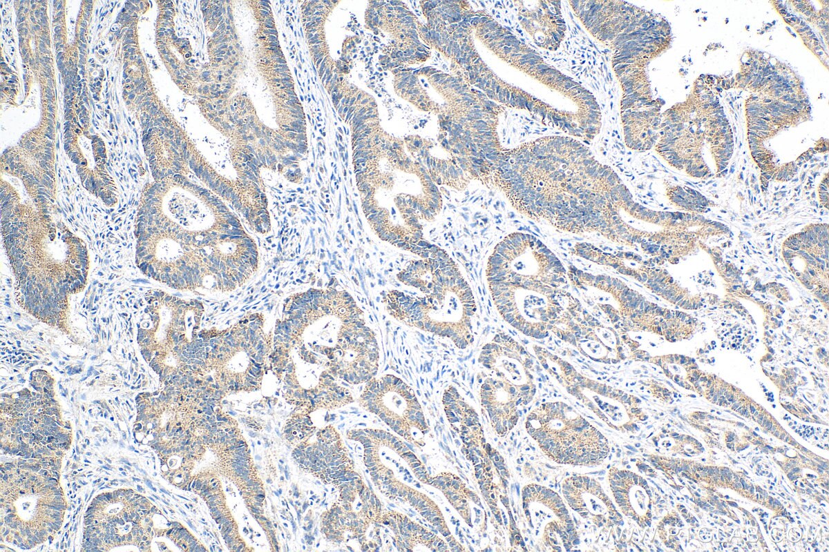 Immunohistochemistry (IHC) staining of human colon cancer tissue using FBXW11 Monoclonal antibody (68090-1-Ig)