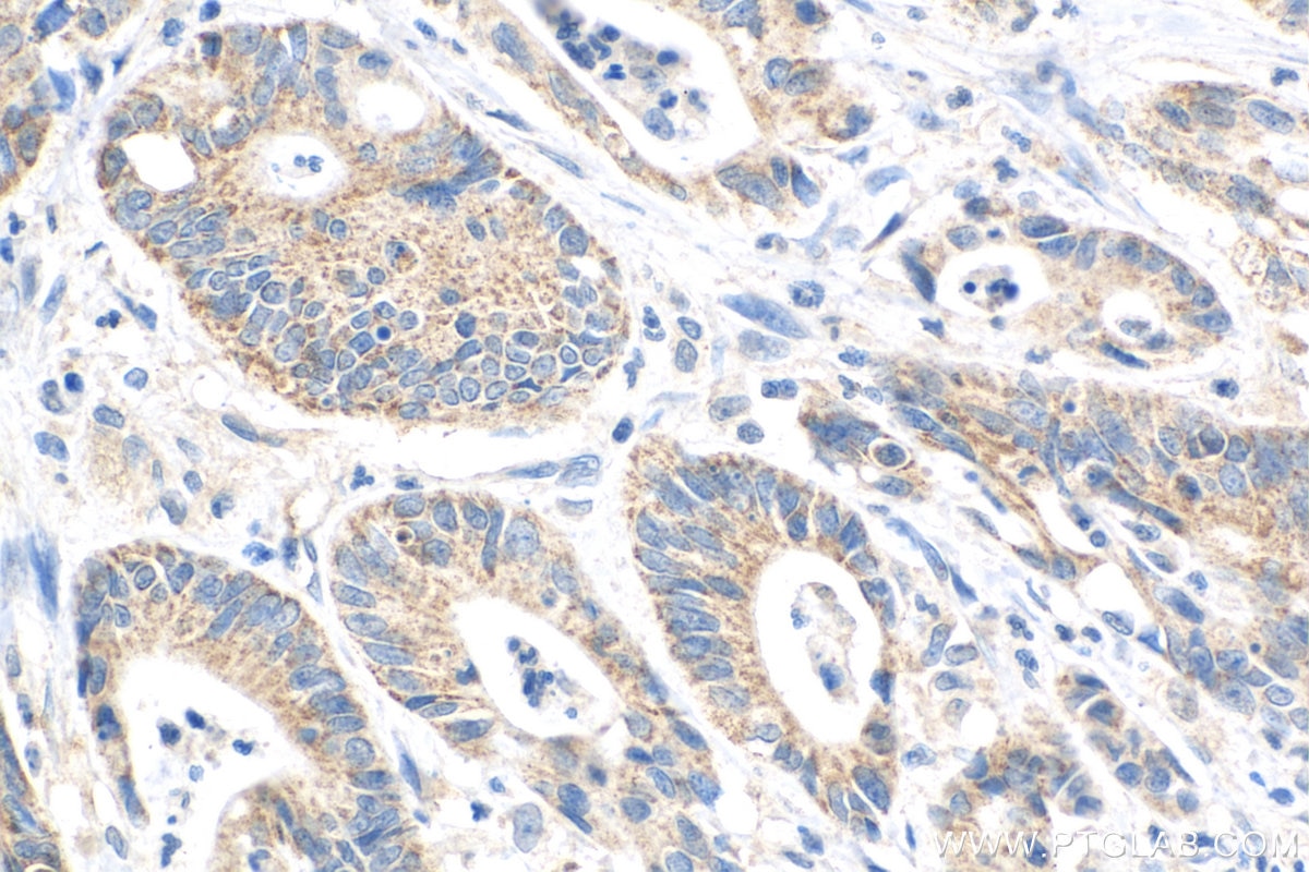 Immunohistochemistry (IHC) staining of human colon cancer tissue using FBXW11 Monoclonal antibody (68090-1-Ig)