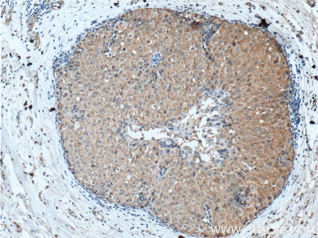 Immunohistochemistry (IHC) staining of human breast cancer tissue using FBXW12 Polyclonal antibody (21687-1-AP)
