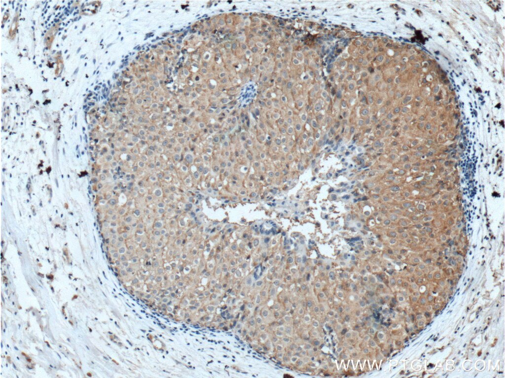 Immunohistochemistry (IHC) staining of human breast cancer tissue using FBXW12 Polyclonal antibody (21687-1-AP)