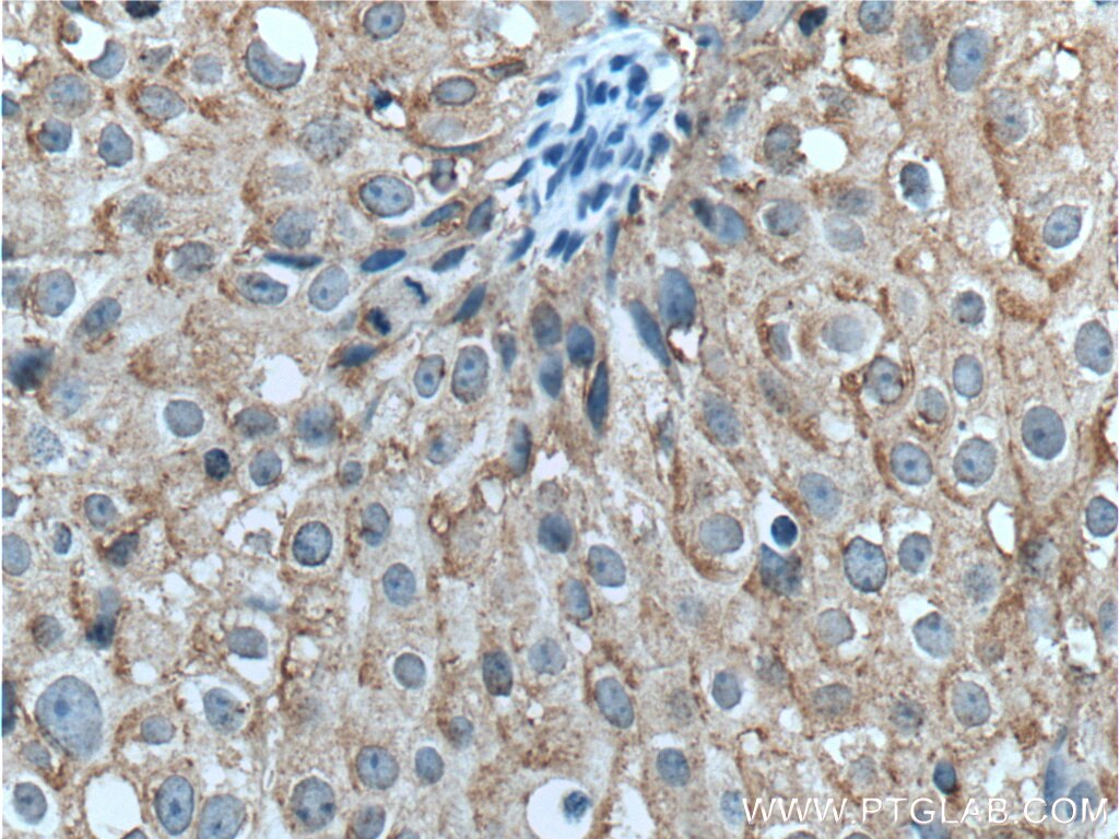 Immunohistochemistry (IHC) staining of human breast cancer tissue using FBXW12 Polyclonal antibody (21687-1-AP)