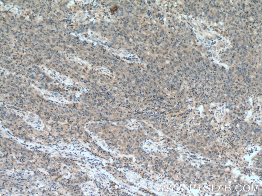 Immunohistochemistry (IHC) staining of human colon cancer tissue using FBXW2 Polyclonal antibody (11499-1-AP)
