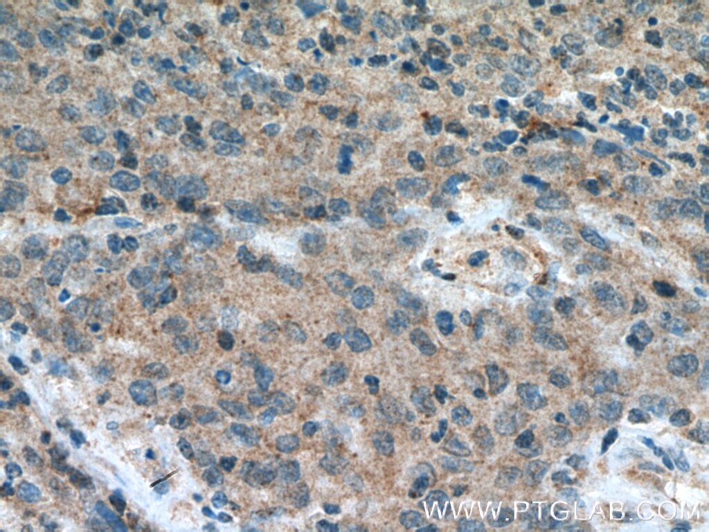 Immunohistochemistry (IHC) staining of human colon cancer tissue using FBXW2 Polyclonal antibody (11499-1-AP)
