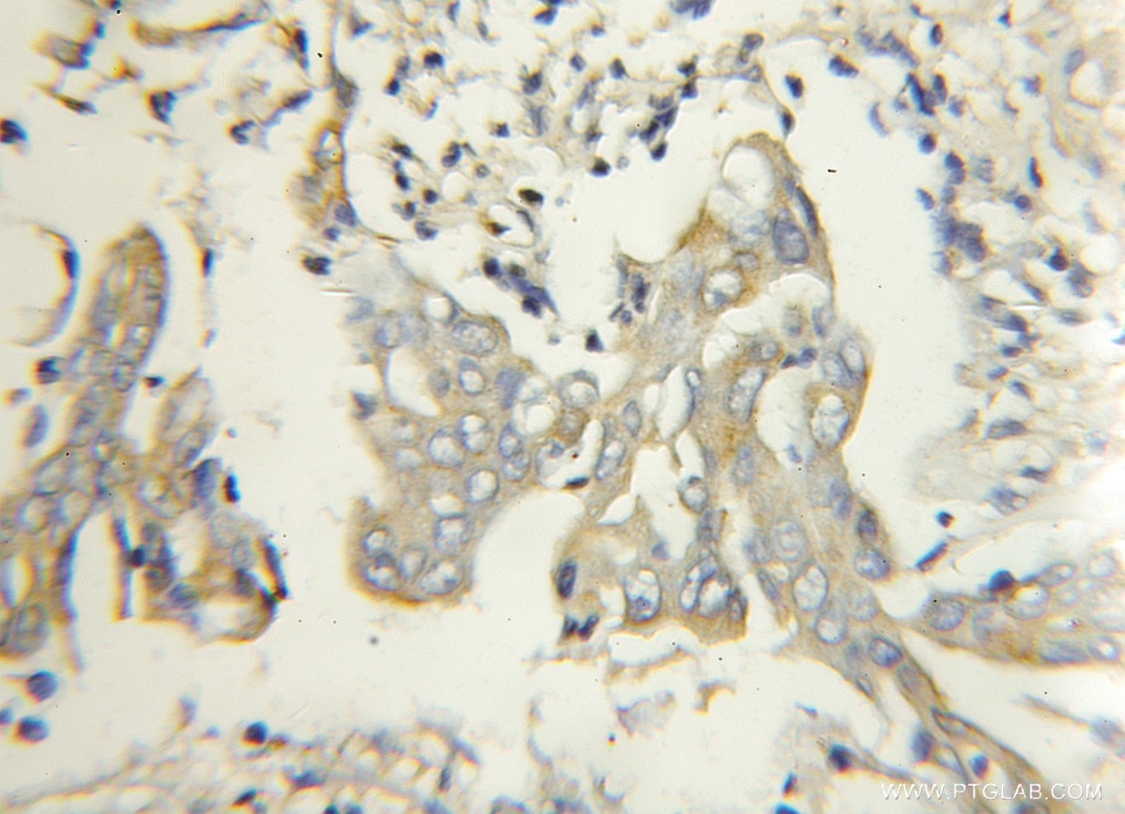 IHC staining of human colon cancer using 11499-1-AP
