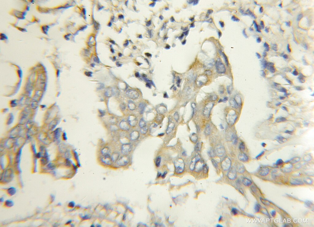 Immunohistochemistry (IHC) staining of human colon cancer tissue using FBXW2 Polyclonal antibody (11499-1-AP)