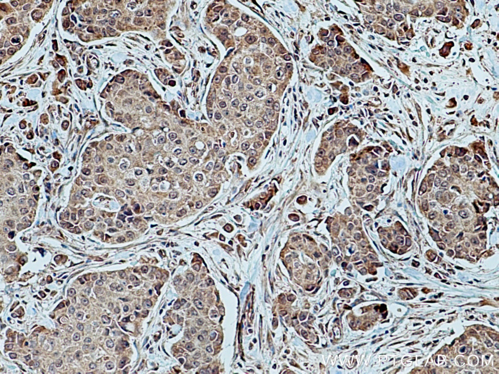 Immunohistochemistry (IHC) staining of human breast cancer tissue using FBXW7 Polyclonal antibody (28424-1-AP)