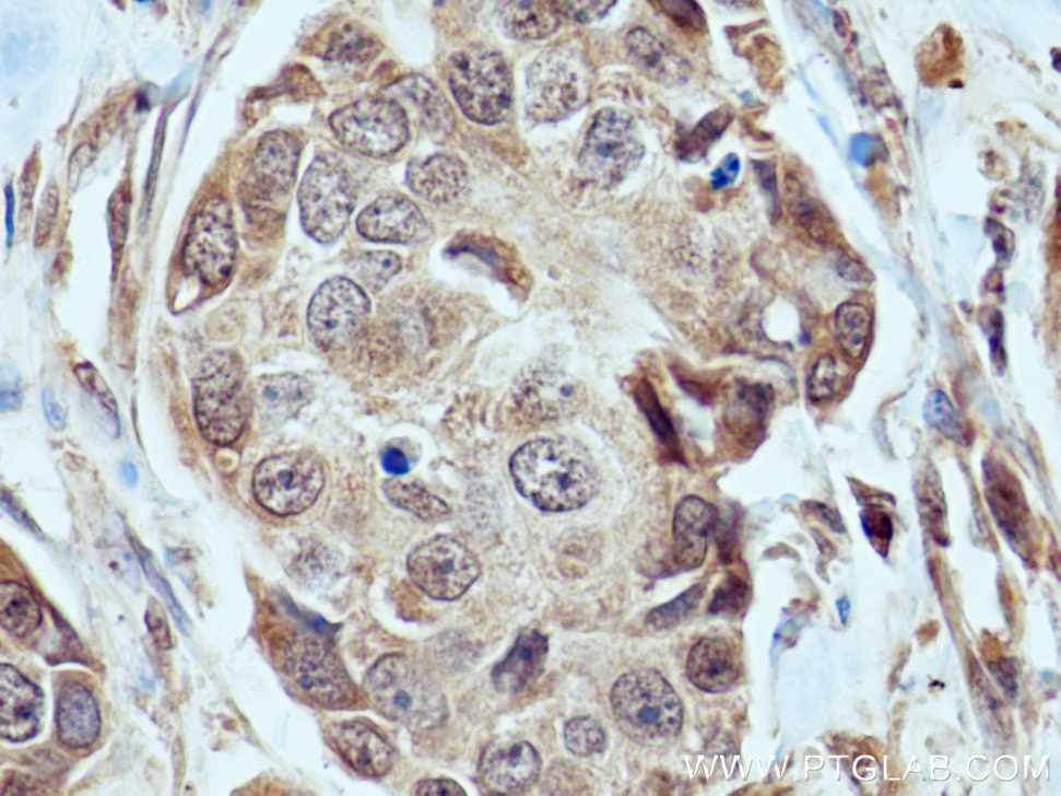 Immunohistochemistry (IHC) staining of human breast cancer tissue using FBXW7 Polyclonal antibody (28424-1-AP)