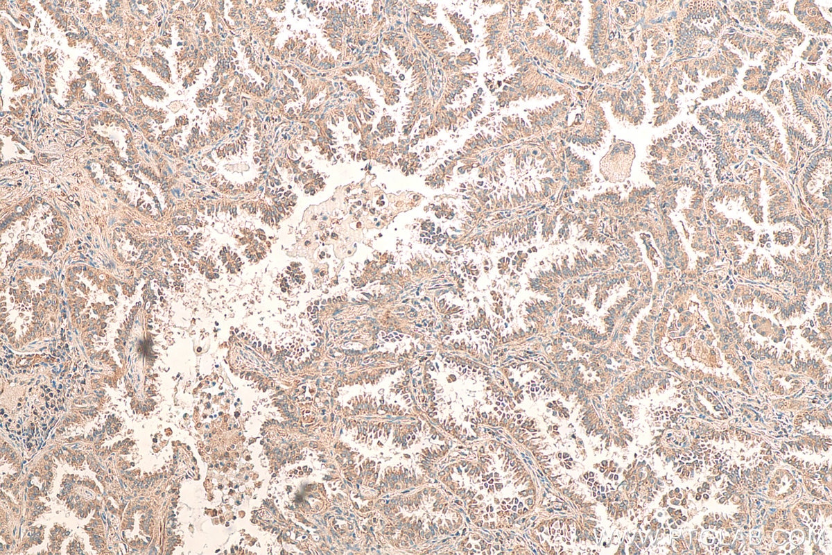 Immunohistochemistry (IHC) staining of human lung cancer tissue using FBXW7 Polyclonal antibody (28424-1-AP)
