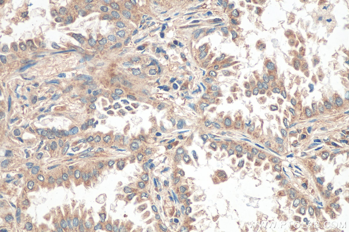 Immunohistochemistry (IHC) staining of human lung cancer tissue using FBXW7 Polyclonal antibody (28424-1-AP)