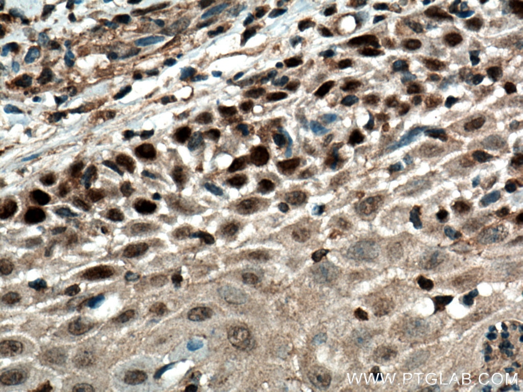 Immunohistochemistry (IHC) staining of human skin cancer tissue using FBXW7 Polyclonal antibody (55290-1-AP)