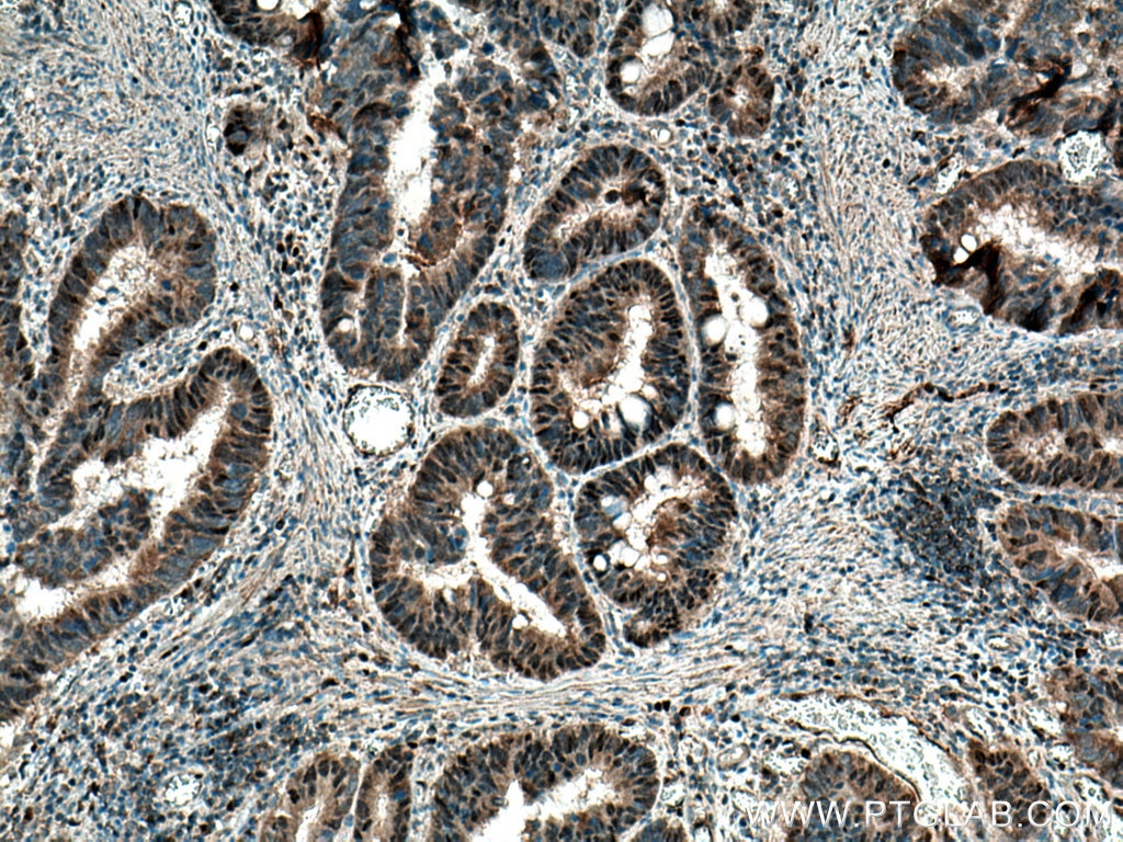 Immunohistochemistry (IHC) staining of human colon cancer tissue using FBXW7 Polyclonal antibody (55290-1-AP)