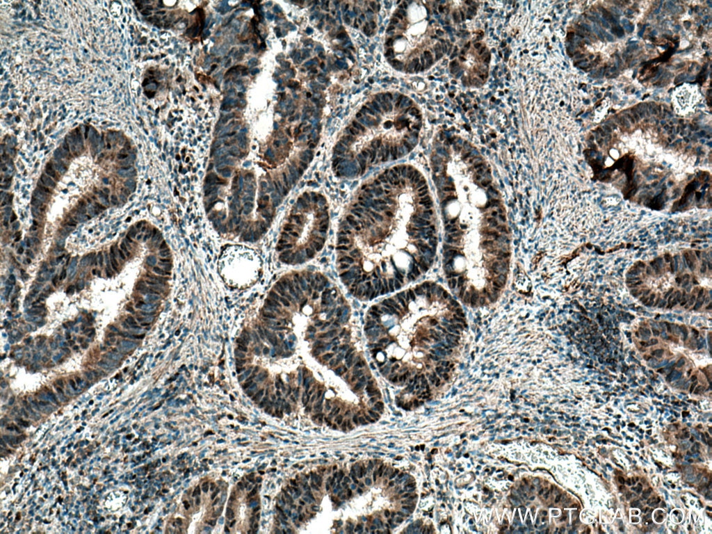 IHC staining of human colon cancer using 55290-1-AP