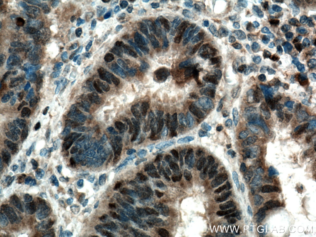 Immunohistochemistry (IHC) staining of human colon cancer tissue using FBXW7 Polyclonal antibody (55290-1-AP)