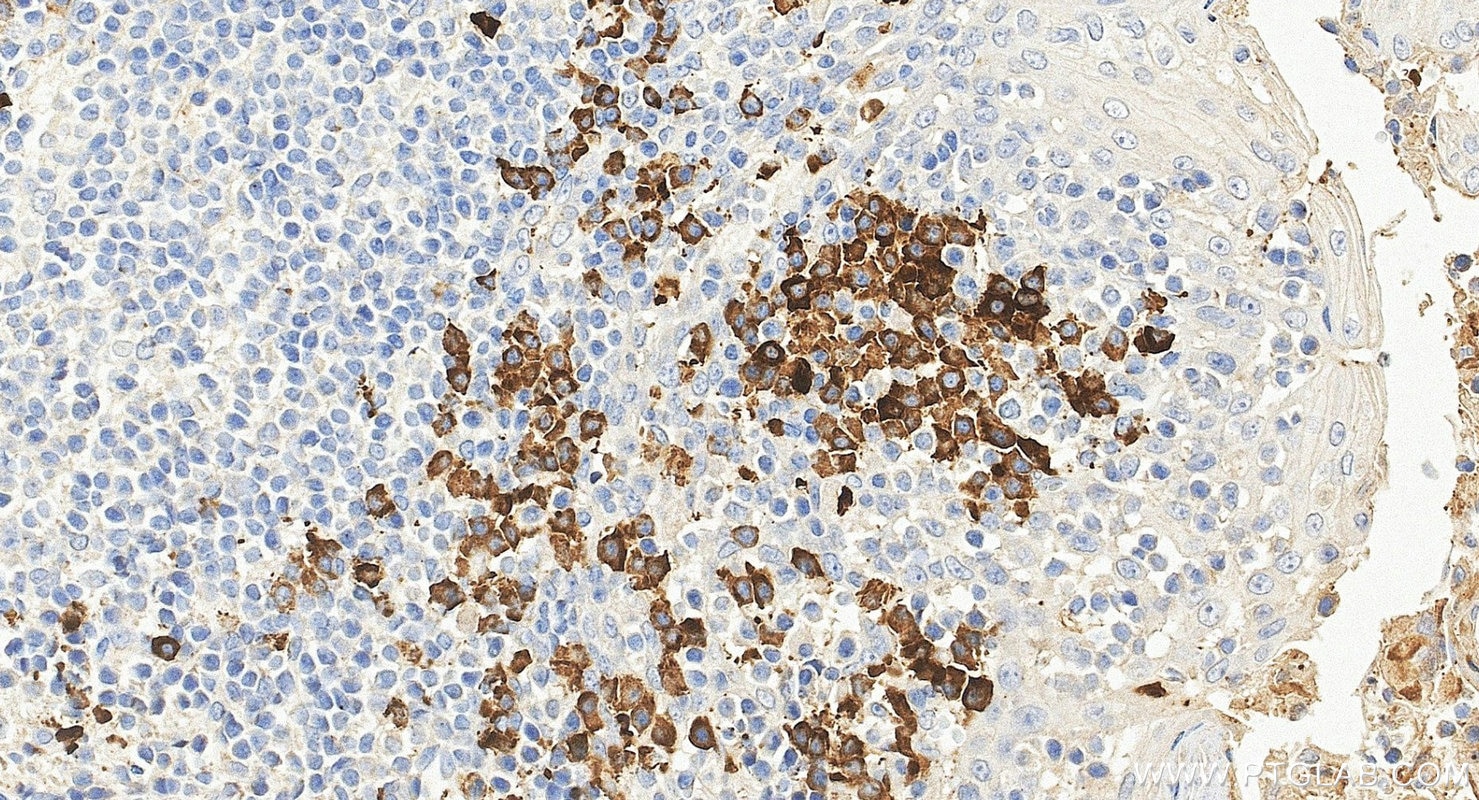 IHC staining of human tonsillitis using 68275-1-Ig Immunohistochemistry (IHC) staining of human tonsillitis tissue using FC of Human IgG Monoclonal antibody (68275-1-Ig)