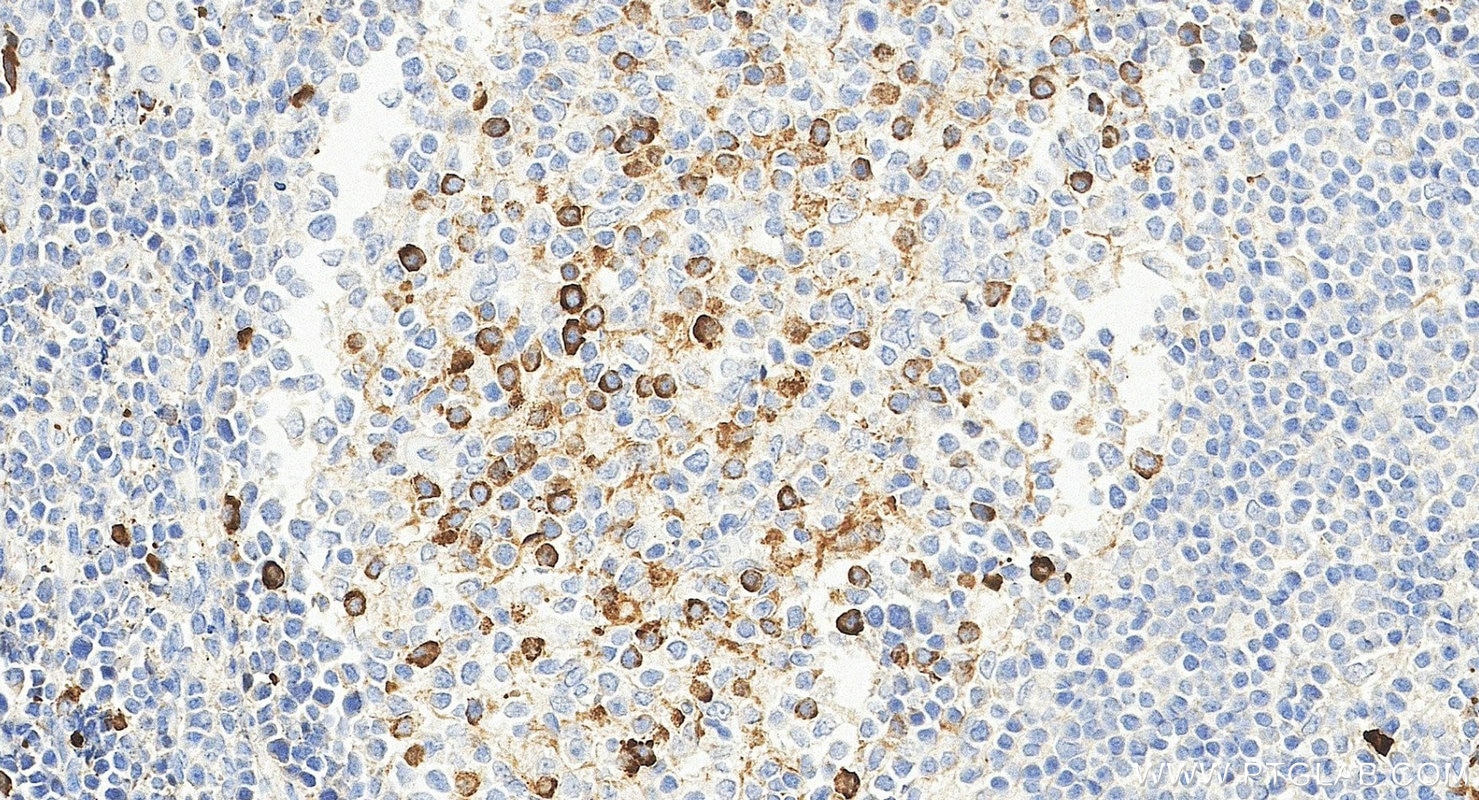 IHC staining of human tonsillitis using 68275-1-Ig Immunohistochemistry (IHC) staining of human tonsillitis tissue using FC of Human IgG Monoclonal antibody (68275-1-Ig)