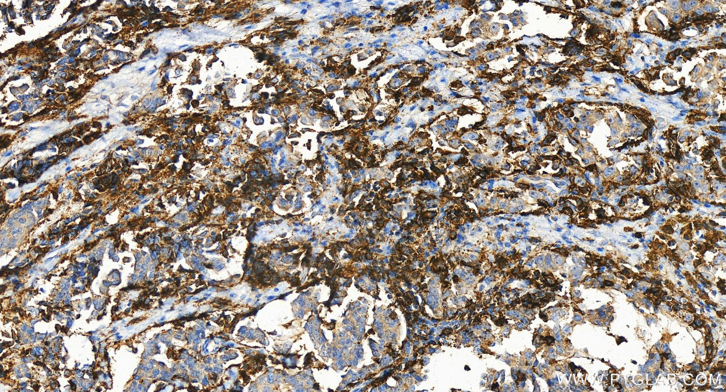 Immunohistochemistry (IHC) staining of human ovary cancer tissue using FCER1G Polyclonal antibody (13566-1-AP)