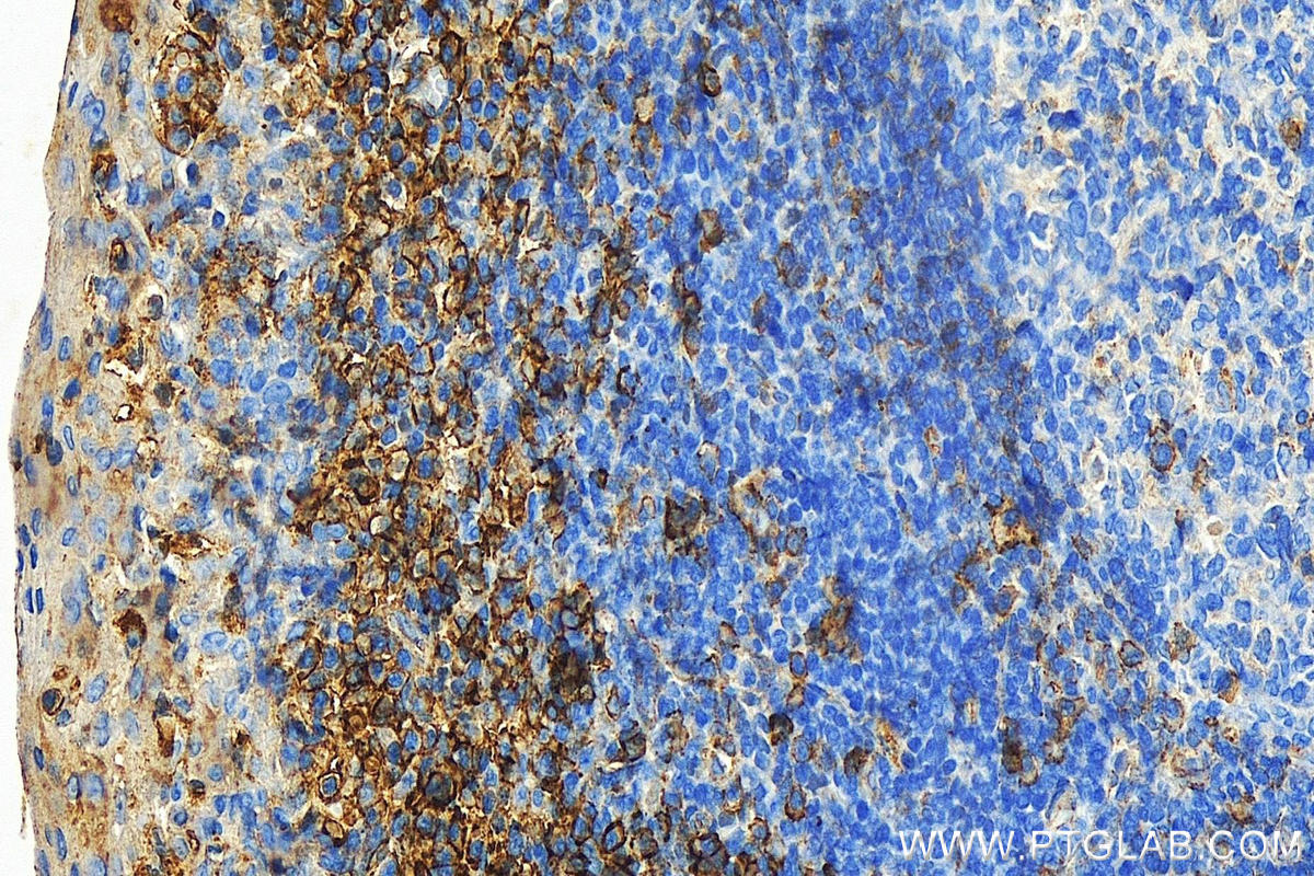 Immunohistochemistry (IHC) staining of human tonsillitis tissue using FCGR2B / CD32b Polyclonal antibody (21541-1-AP)