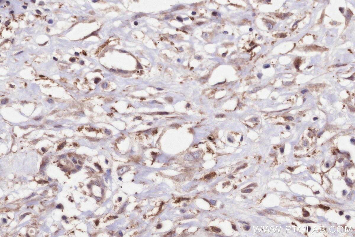 Immunohistochemistry (IHC) staining of human colon cancer tissue using FcRn-Specific Polyclonal antibody (16190-1-AP)