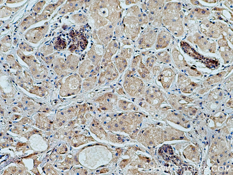 Immunohistochemistry (IHC) staining of human breast cancer tissue using FCHSD1 Polyclonal antibody (23362-1-AP)