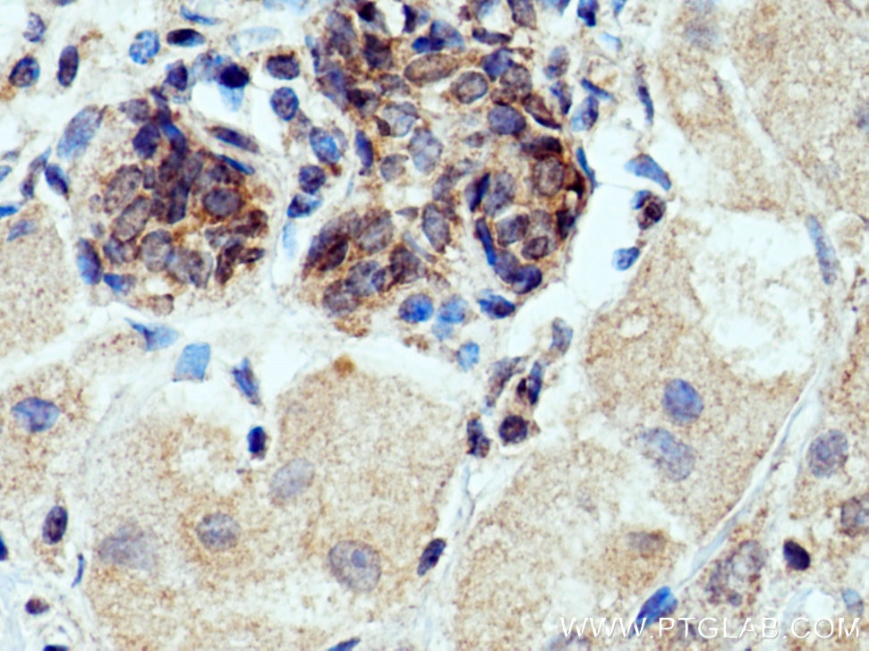 Immunohistochemistry (IHC) staining of human breast cancer tissue using FCHSD1 Polyclonal antibody (23362-1-AP)