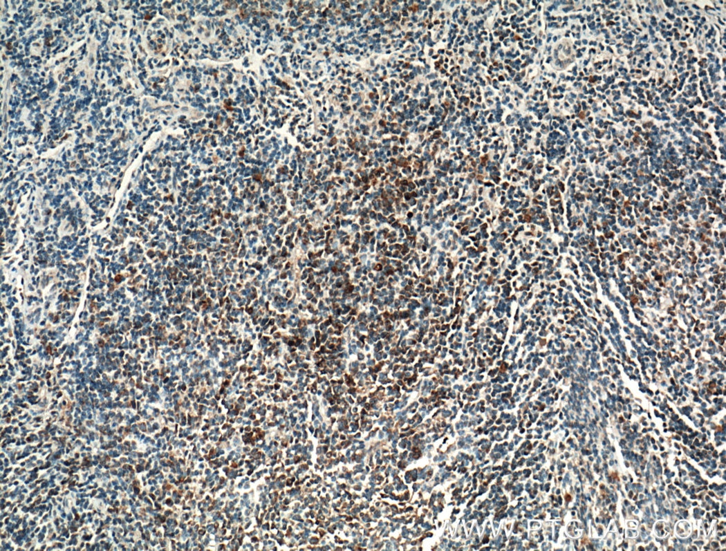 Immunohistochemistry (IHC) staining of human tonsillitis tissue using FCRLA Polyclonal antibody (26949-1-AP)