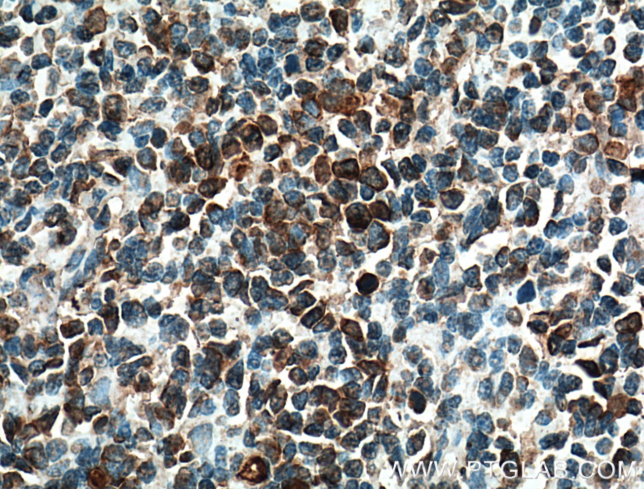 Immunohistochemistry (IHC) staining of human tonsillitis tissue using FCRLA Polyclonal antibody (26949-1-AP)