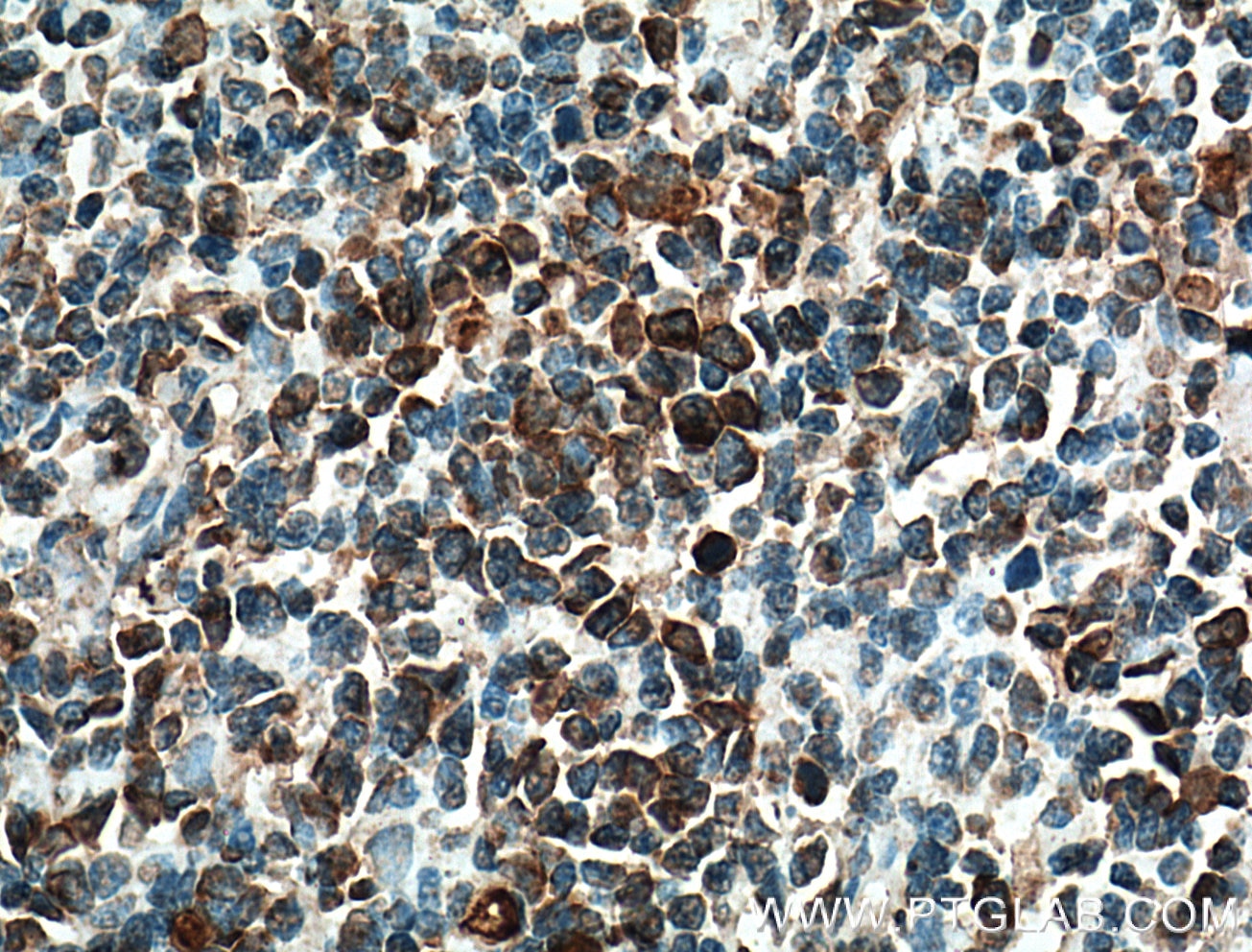 IHC staining of human tonsillitis using 26949-1-AP