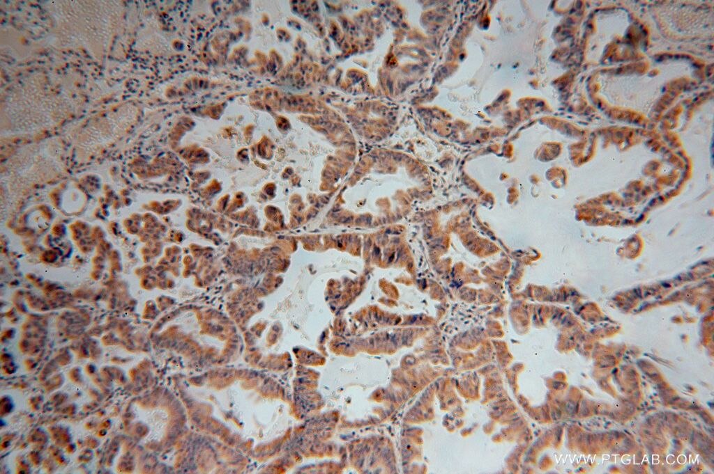 Immunohistochemistry (IHC) staining of human lung cancer tissue using FCRLB Polyclonal antibody (17157-1-AP)