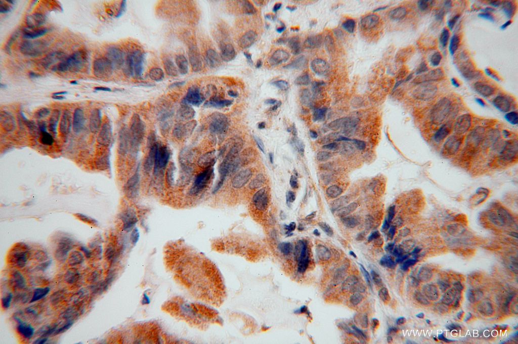 Immunohistochemistry (IHC) staining of human lung cancer tissue using FCRLB Polyclonal antibody (17157-1-AP)