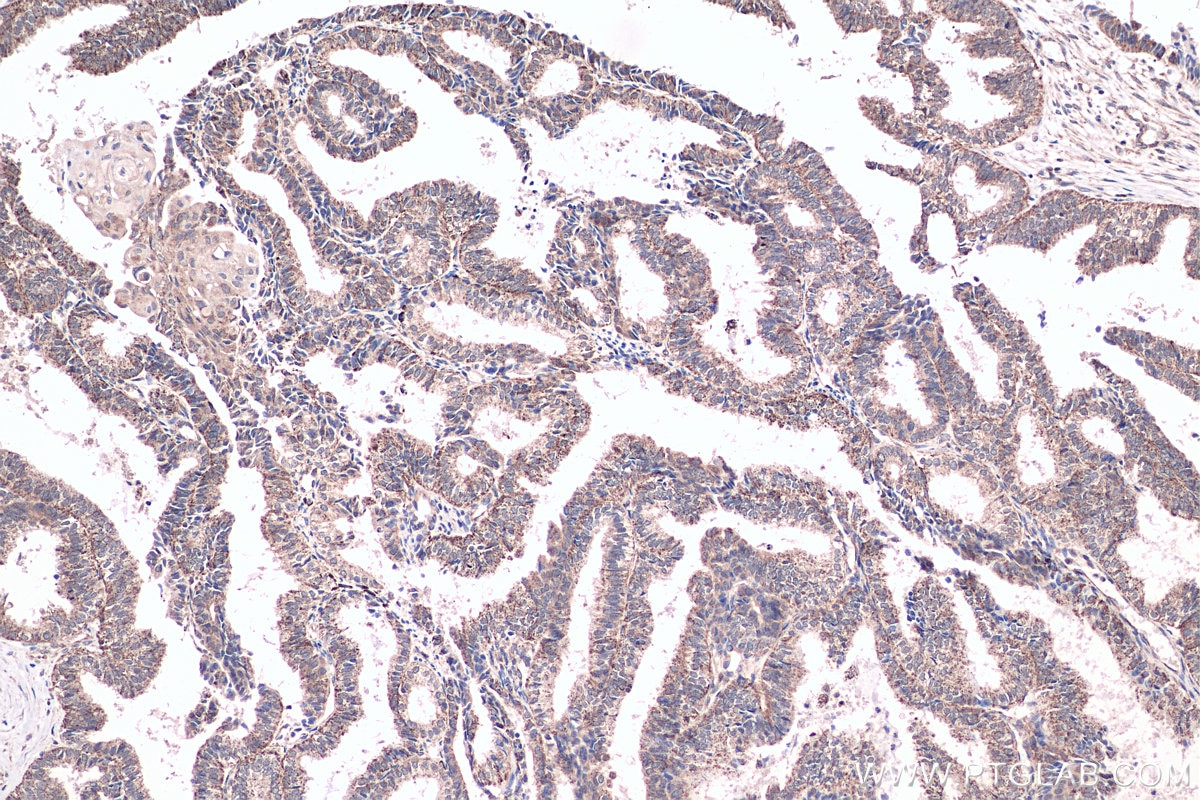 Immunohistochemistry (IHC) staining of human ovary tumor tissue using FDX1 Polyclonal antibody (12592-1-AP)