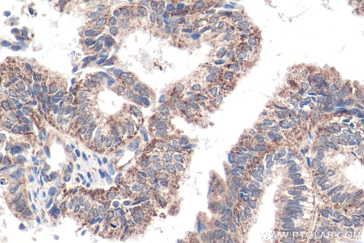 Immunohistochemistry (IHC) staining of human ovary tumor tissue using FDX1 Polyclonal antibody (12592-1-AP)