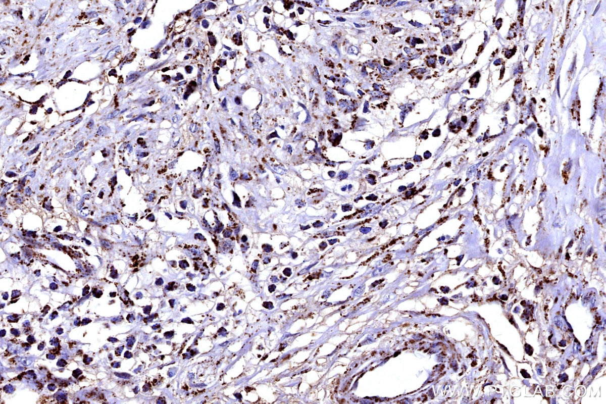 IHC staining of human colon cancer using 12592-1-AP Immunohistochemistry (IHC) staining of human colon cancer tissue using FDX1 Polyclonal antibody (12592-1-AP)