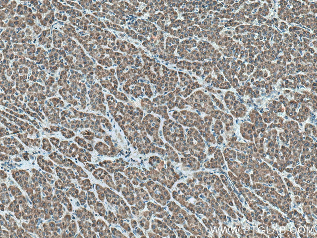 Immunohistochemistry (IHC) staining of human liver cancer tissue using FDXR Polyclonal antibody (15584-1-AP)