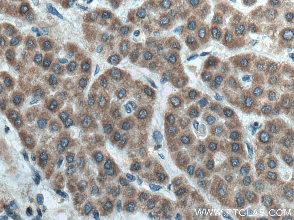 Immunohistochemistry (IHC) staining of human liver cancer tissue using FDXR Polyclonal antibody (15584-1-AP)