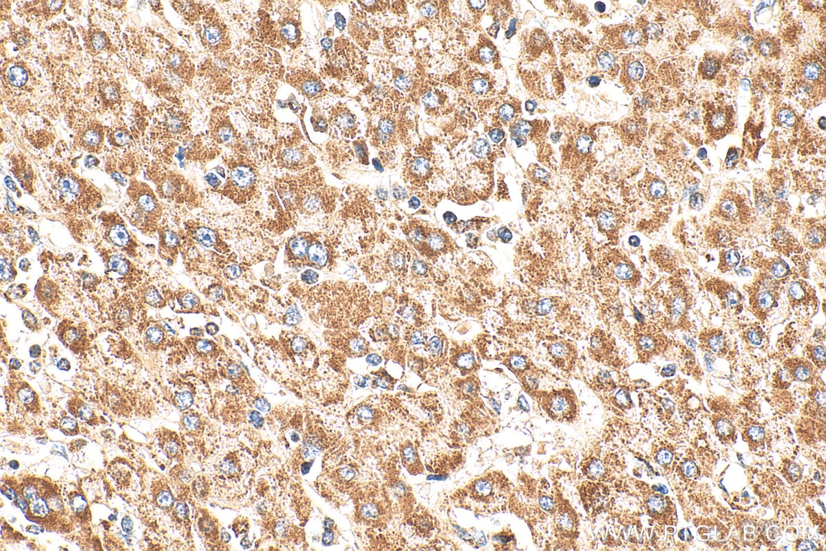 Immunohistochemistry (IHC) staining of human liver cancer tissue using FECH Polyclonal antibody (14466-1-AP)