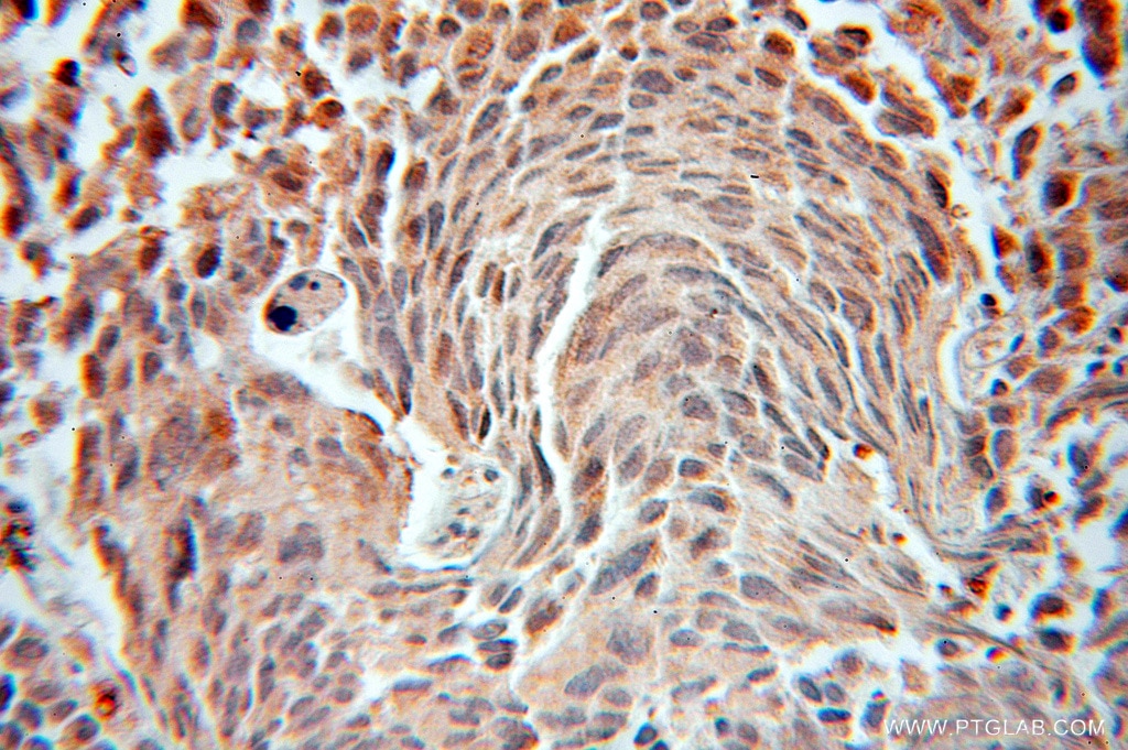 Immunohistochemistry (IHC) staining of human prostate cancer tissue using FEM1B Polyclonal antibody (11030-1-AP)