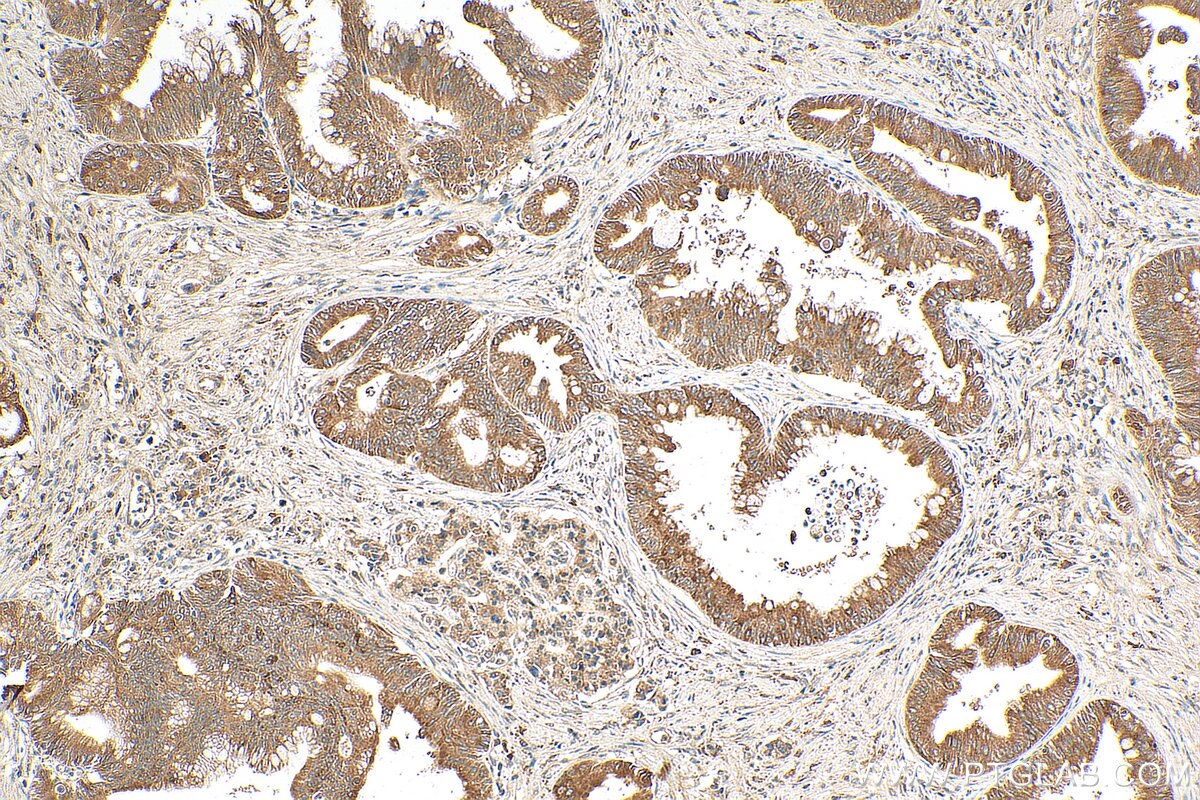 IHC staining of human pancreas cancer using 19544-1-AP