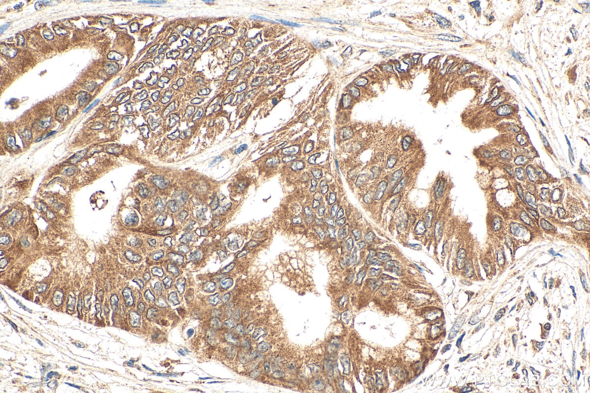 Immunohistochemistry (IHC) staining of human pancreas cancer tissue using FEM1B Polyclonal antibody (19544-1-AP)