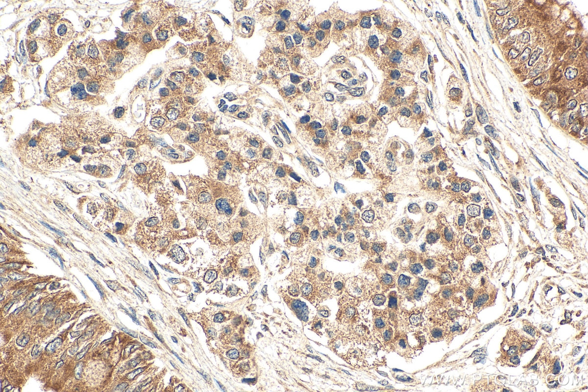 Immunohistochemistry (IHC) staining of human pancreas cancer tissue using FEM1B Polyclonal antibody (19544-1-AP)