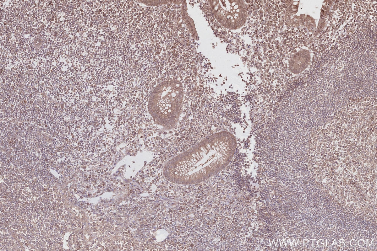 Immunohistochemistry (IHC) staining of human appendicitis tissue using FEM1C Polyclonal antibody (14037-1-AP)