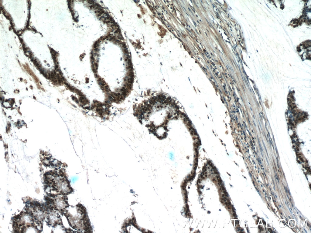 IHC staining of human colon cancer using 14768-1-AP