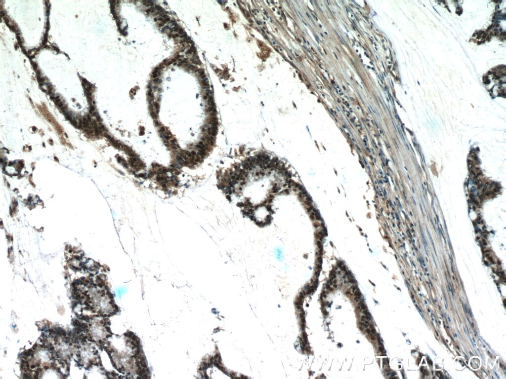 Immunohistochemistry (IHC) staining of human colon cancer tissue using FEN1 Polyclonal antibody (14768-1-AP)