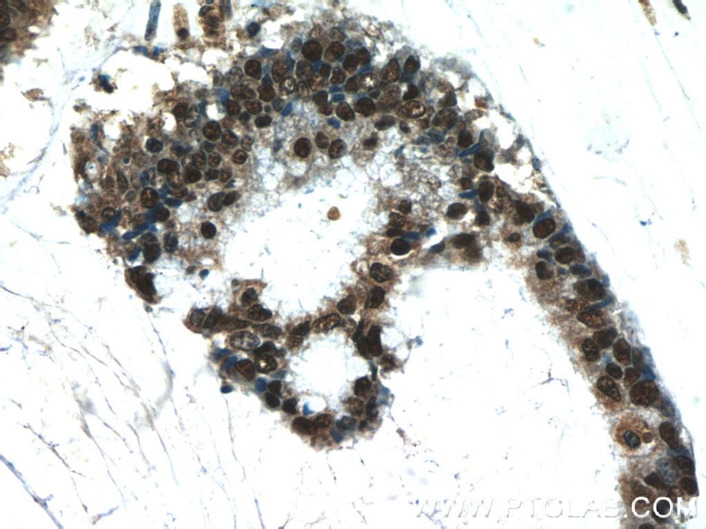 Immunohistochemistry (IHC) staining of human colon cancer tissue using FEN1 Polyclonal antibody (14768-1-AP)