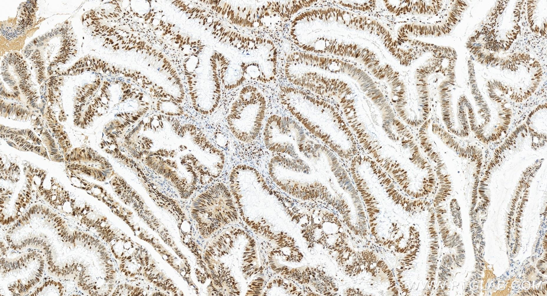 Immunohistochemistry (IHC) staining of human colon cancer tissue using FEN1 Recombinant antibody (84916-5-RR)